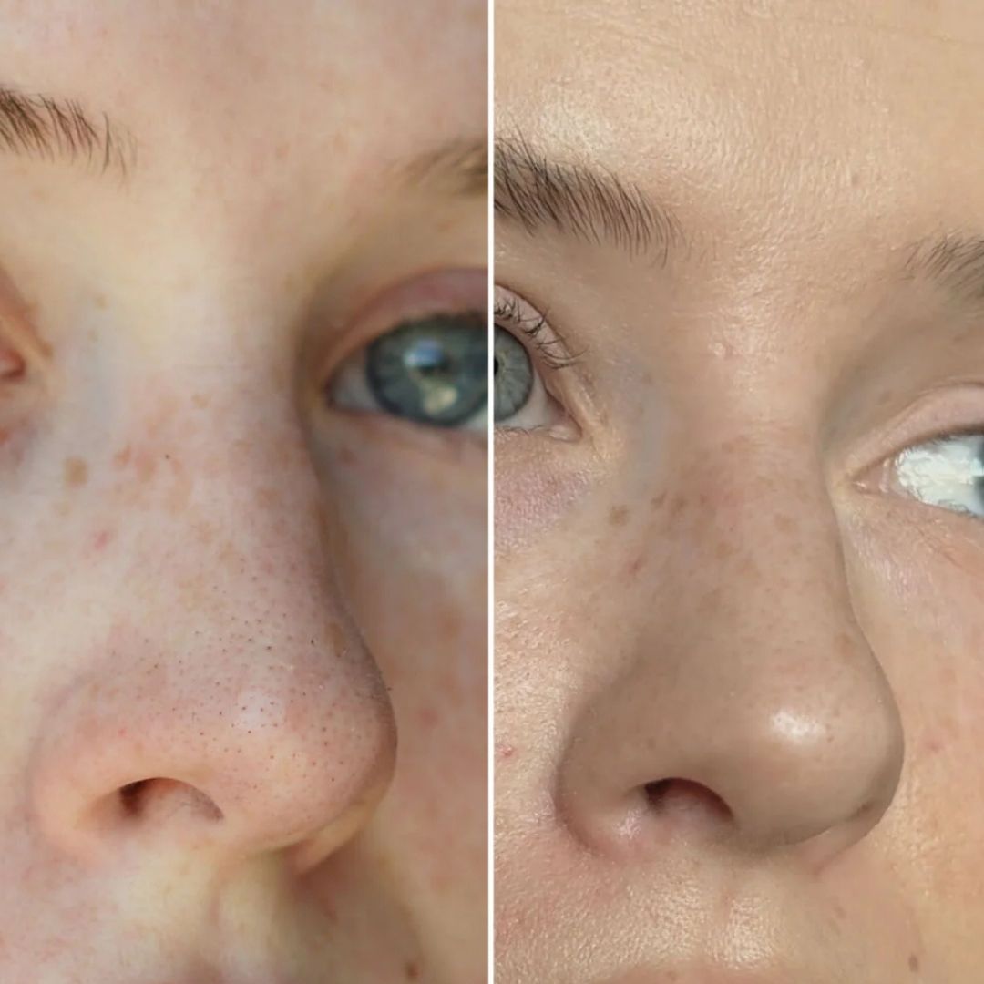 Parches Clarity™ Limpia tu nariz