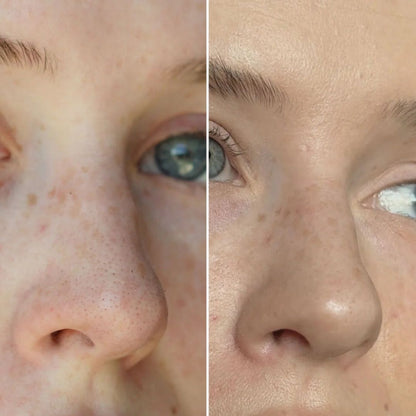 Parches Clarity™ Limpia tu nariz