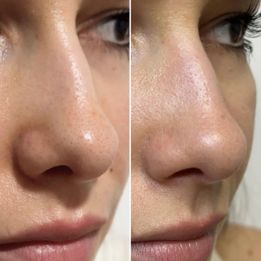 Parches Clarity™ Limpia tu nariz