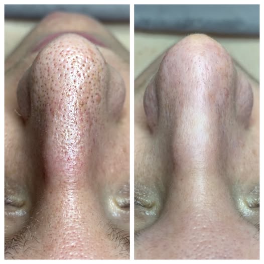 Parches Clarity™ Limpia tu nariz